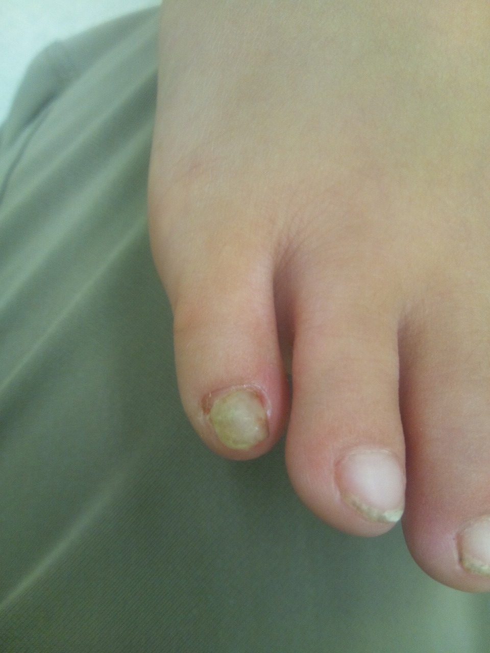 爪 変色 子供 足の爪が黒い！親指が変色！原因と対処方法・メラノーマの見分け方