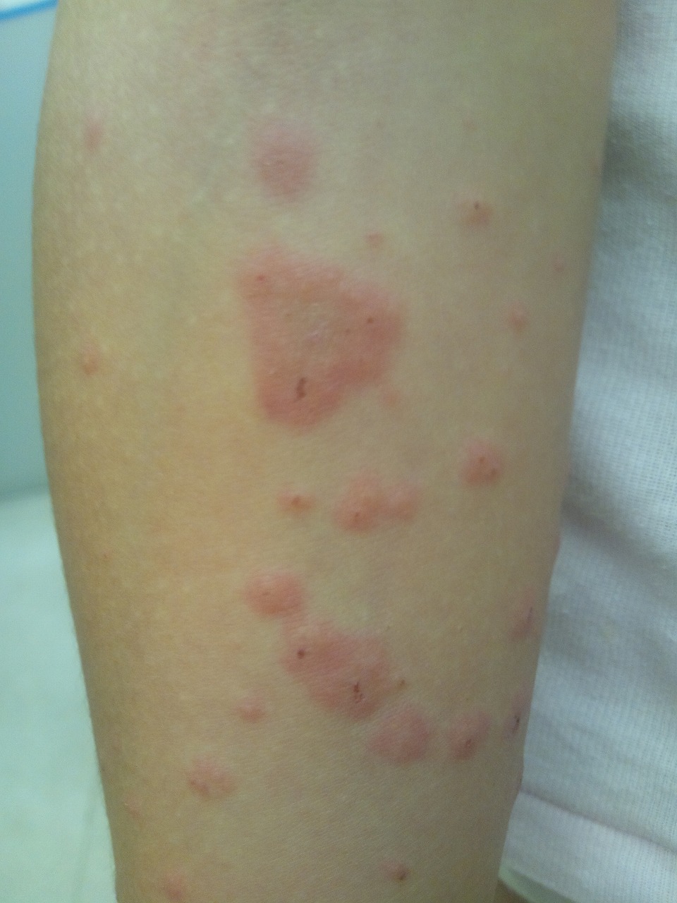 お腹 赤い斑点 かゆくない お腹のブツブツの６つの原因！赤い湿疹やかゆみがある場合は。