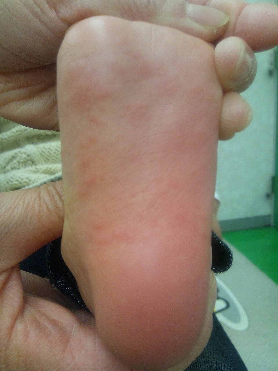 かゆい 足 の 甲 足に赤い斑点ができるのは感染や内出血が原因！？考えられる原因や病気を徹底解説！ 症状の原因・病気一覧・診療科