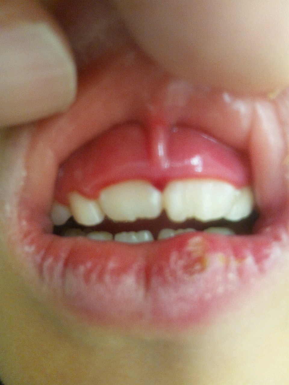 腫れ 子供 歯茎