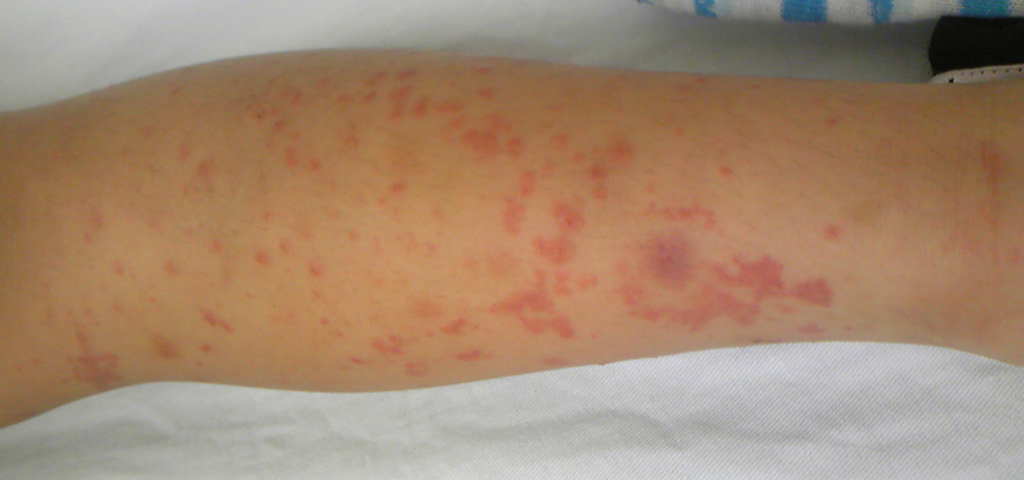 血管性紫斑病 アレルギー性紫斑病