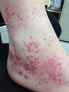 ない 痒く 足 赤い 斑点 に 腕に赤い斑点が出来るのは病気？かゆみがある場合とない場合で分かる原因を知ろう！
