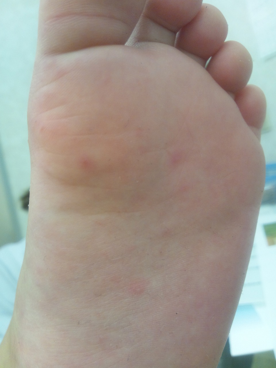 痒い が の あし うら 足の裏の痒い原因とは？原因や湿疹についても解説