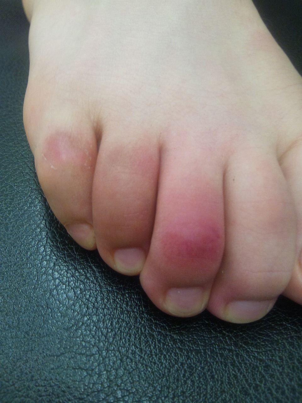 て 痛い 指 の 血管 が 腫れ 足の指の腫れ：医師が考える原因と対処法｜症状辞典