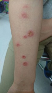 カポジ水痘様発疹症（腕）②