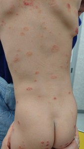 結節性痒疹（背中）