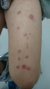 カボジ水痘様発疹症（太もも）治療後