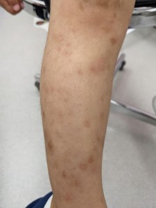 痒疹(右足）治癒後