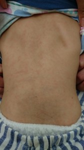 多型滲出性紅斑（背中）④治療後