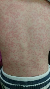 インフルエンザによる多型滲出性紅斑（背中）