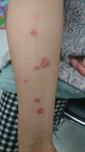 カポジ水痘様発疹症（腕）②治療後