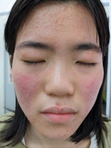 スギによるアトピー性皮膚炎の顔の悪化とにきび治癒後
