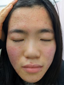 スギによるアトピー性皮膚炎の顔の悪化とにきび