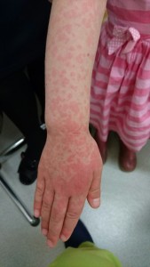 インフルエンザによる多型滲出性紅斑（右手）