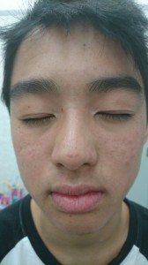 アトピー性皮膚炎（顔）⑦⑧治療後