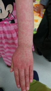 インフルエンザによる多型滲出性紅斑（左手）