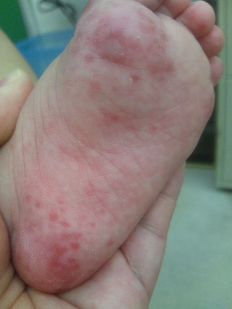 斑点 手足 赤い 皮膚の赤い斑点は病気？かゆみがあるなしでの７つの原因と対処法！